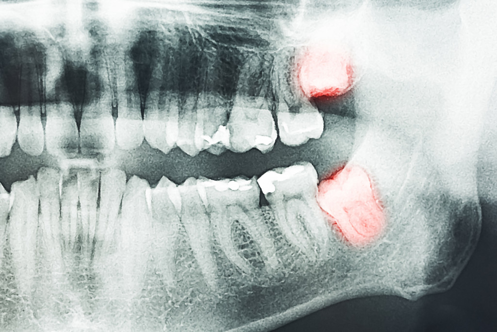 xray of wisdom tooth for extraction