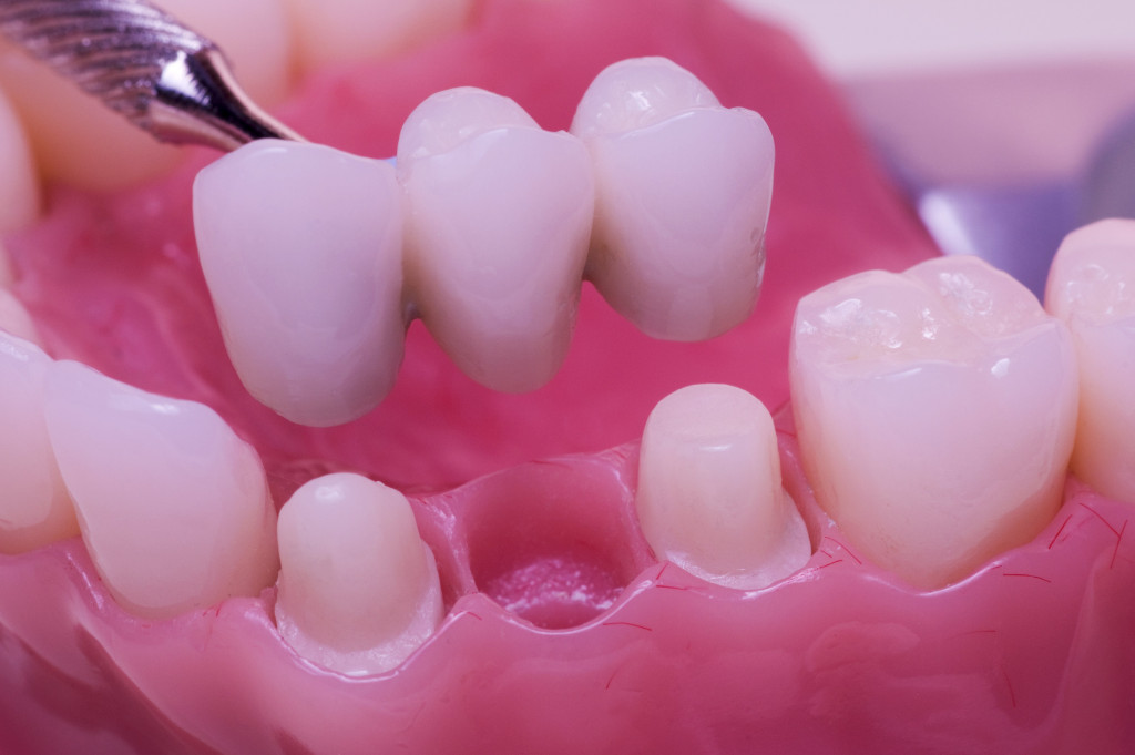a model sample of dental bridge application